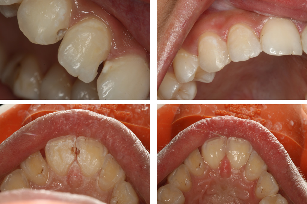 Decay between teeth replaced with a tooth color filling