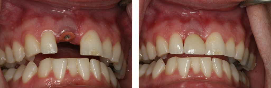 Single Tooth Implant - Front Tooth