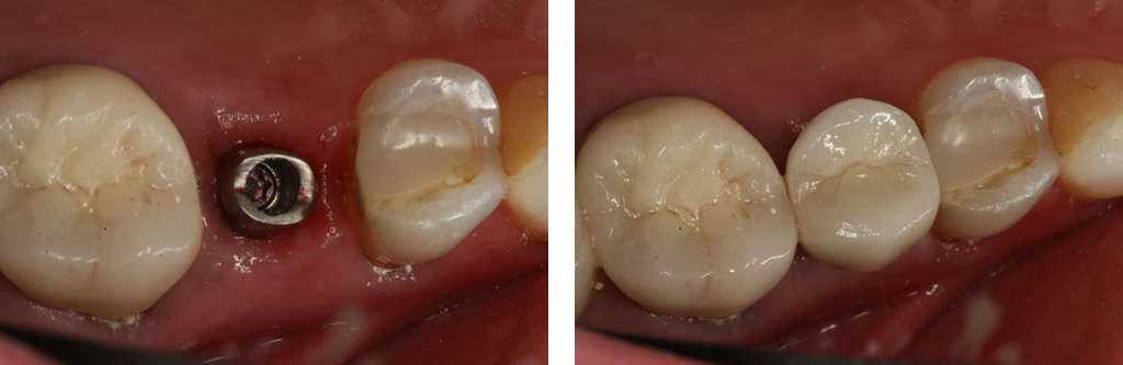 Single Tooth Implant - Back Tooth